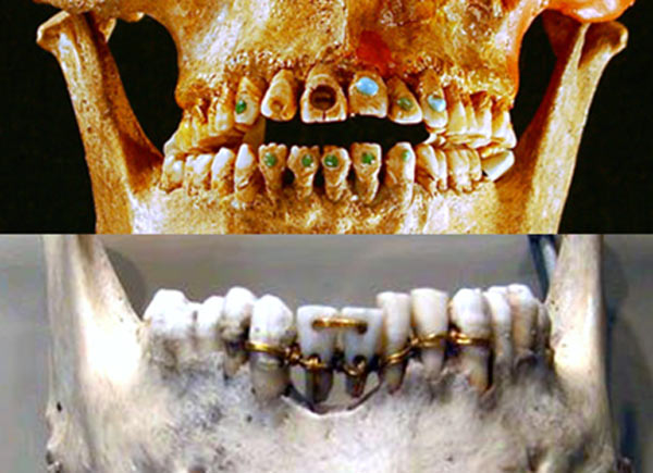 Gold bridges and jewel-adorned teeth were performed in ancient dentistry.