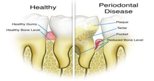 Healthy vs. Diseased Periodontium